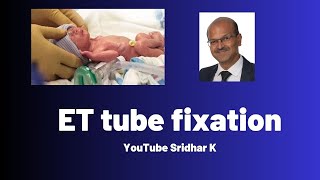 ET tube fixation l How to fix tube securely in babies [upl. by Eceerehs]