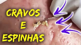 Como Remover Cravos do Rosto  Removendo CRAVOS e ESPINHAS GIGANTES 014 [upl. by Pavlov636]