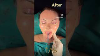 Scarless Facelift facelift necklift drsuleymantas beforeandafter tasmedicalcenter [upl. by Refotsirc]