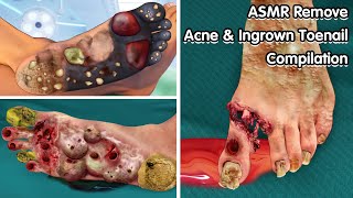 ASMR Remove Acne amp Ingrown Toenail Compilation  Deep Cleaning Animation [upl. by Plank]