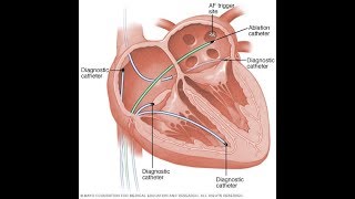 Tratamiento de arritmia ablación cardïaca por radiofrecuencia [upl. by Wilbert]