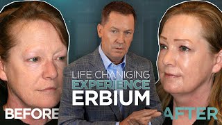 No Scalpels No Facelift See How Erbium Laser Restores Youthful Skin [upl. by Jemie]