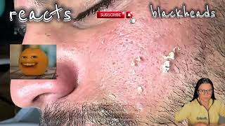 blackhead removal blackhead extraction blackhea [upl. by Eirahcaz]