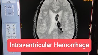 How to Diagnose Intraventricular Hemorrhage on MRI of Brain [upl. by Nawram]