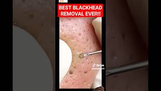 Best BLACKHEAD REMOVAL Ever  So Satisfying shorts [upl. by Fasta]