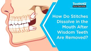 How do stitches dissolve in the mouth after wisdom teeth are removed [upl. by Oos]