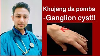 khut khujeng da pomba ganglion cyst [upl. by Enoyrt]