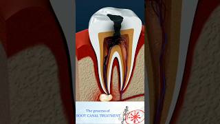 Root Canal Treatment Explained  How to Treat a Tooth Abscess Shorts [upl. by Thorrlow]