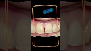 Teeth  Teeth gap filling  Teeth gap filling treatment [upl. by Rheims858]