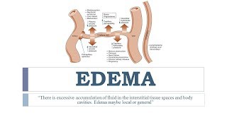 Edema types grading cause pathophysiology treatment and recommendations 🏥 [upl. by Germaun]