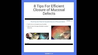 8 Tips For Efficient Closure of Mucosal Defects [upl. by Luapnoj609]