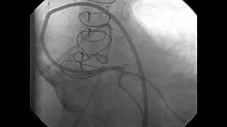 Left Ventricular Dysfunction after Heart Transplantation [upl. by Nugent]