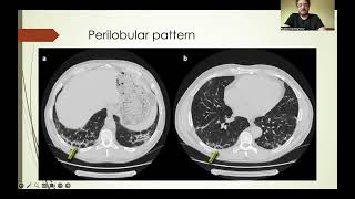 Reticular opacities part 1 English version [upl. by Juta]