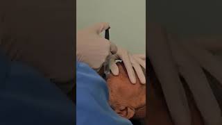 RETROBULBAR ANESTHESIA CATRACT SURGERY ophthalmology mbbs medico doctor surgeon anestesia [upl. by Eanod]