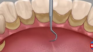 ASMR dental tartar removal animationteeth animation [upl. by Anierdna881]