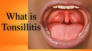 What is Tonsillitis Tonsils Kia hain Bachun me tonsils ka ilaj in UrduHindi [upl. by Juanne]