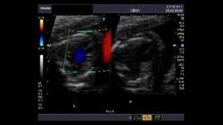 Ultrasound at 19 Weeks 3 Days [upl. by Esenej]