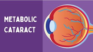 Metabolic cataract  Ophthalmology  Medical science cataract [upl. by Koosis420]