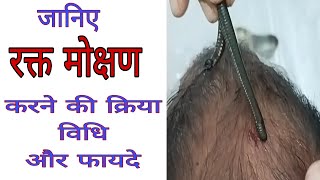 Role of Leech Therapy in Ayurveda  Panchakarma ki Vidhi leechtherapy raktamokshana panchakarma [upl. by Ardaid711]