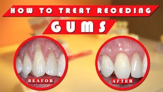 Receding gums How to stop receding gums at home naturally [upl. by Oren]