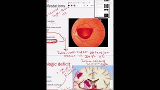 Intracerebral Hemorrhage  Part 2 [upl. by Petulah]