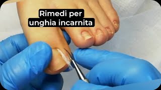 Rimedi per unghia incarnita Come applicare il cotone sotto lunghia incarnita [upl. by Rafe]