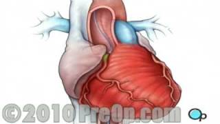 Heart Health Cardiac Catheterization Surgery PreOp® Patient Education [upl. by Cleary]