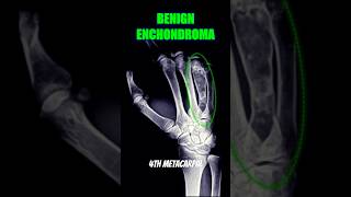 Enchondroma bones xray health [upl. by Nytsrik]