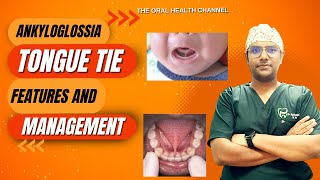 Dr Rudra Mohan  Tongue Tie ANKYLOGLOSSIA at a glance  Symptoms Features and Management [upl. by Roer90]