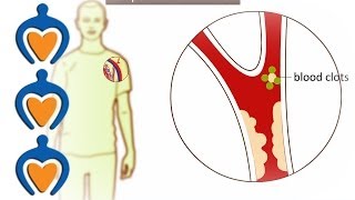 Thrombosis  What is it and how is it treated [upl. by Zaragoza]