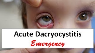 Acute Dacryocystitis Emergency [upl. by Harp]