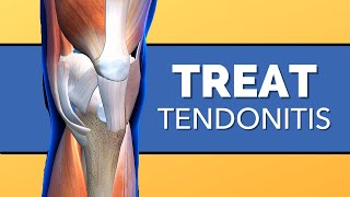 How to Treat Tendonitis of the Knee [upl. by Ettenaej943]