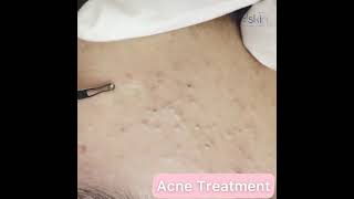 Comedone Extraction Acne Treatment [upl. by Eeroc900]