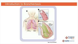 Introduction to Bronchiectasis with Tim Aksamit MD [upl. by Aimaj]