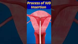 Process Of IUD Insertion viral shorts contraceptives pregnancytips [upl. by Spring326]