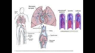 Thrombosis EmbolismViolations microcirculation [upl. by Beaver]