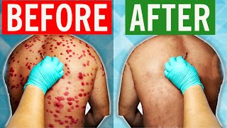 How To Cure Shingles in 2024 [upl. by Norud]