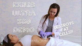 EXILIS ULTRA DEMONSTRATION BODY  Exilis Ultra 360 Experience at EuroPhoria [upl. by Columbine]