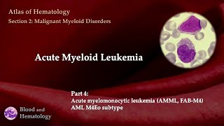 Acute Myeloid Leukemia AML  Part 4 [upl. by Corrina]