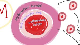 Erythema Multiforme with mnemonic  ALL you need to know [upl. by Martin]