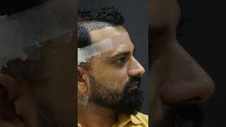 Artas Robotic Hair Transformation in Ahmedabad  Hair Transplant Before and After  Musk Clinic [upl. by Aizitel]