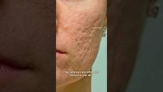 How to get rid of acne scars with Tretinoin  Acne scar Treatment sristydutta acnescars shorts [upl. by Davies]