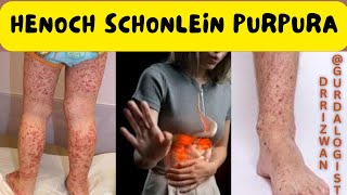 HenochSchonlein Purpura HSP  Symptoms  Cause  Pathology  Biopsy  Treatment  Transplant [upl. by Orvil]