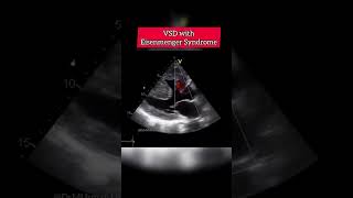 VSD with Eisenmenger Syndrome echocardiography echocardiogram echo shorts [upl. by Beera]