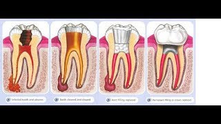 Endodontic treatment  in Sango language [upl. by Dickey]