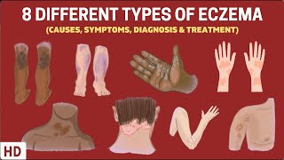 Eczema Exposed 8 Types You Need to Know [upl. by Mairam]