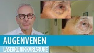 Augenvenen Lasertherapie [upl. by Hiett]