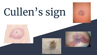 Understanding Cullens Sign  Clinical Significance and Causes [upl. by Netsirk]