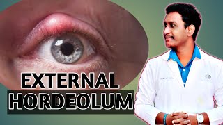 external hordeolum eyelid diseases external hordeolum case presentation 2021 [upl. by Floria149]