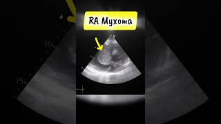 Parasternal short Axis View showing RA myxoma on Echocardiography heart tumor [upl. by Durstin]